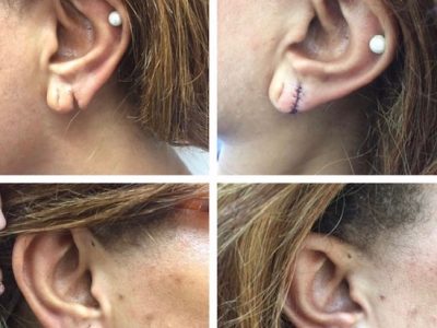 Ear Lobe Split Surgery London